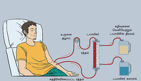 டயாலிசிஸ் சிகிச்சைக்கு அச்சம் வேண்டாம் | மறையாத கட்டுக்கதைகள் 11 