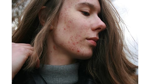 Why adult acne is rising 