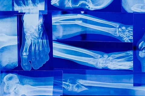 Prioritising bone health: Recognising the signs of weakness