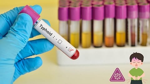 typhoid 