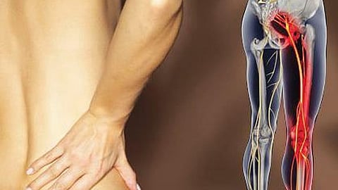 Piriformis Syndrome