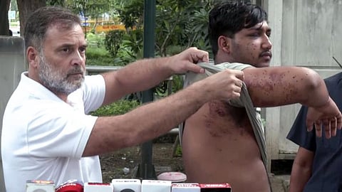 Lok Sabha LoP Rahul Gandhi brings before the media a man he claims suffered pellet gun injuries during students' protest, in New Delhi on Friday.
