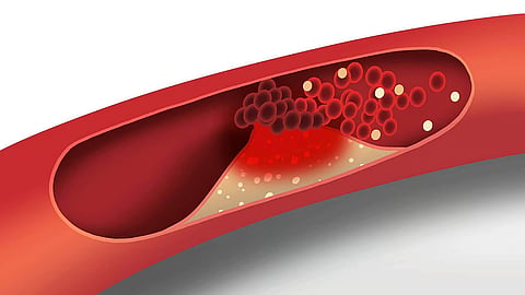 Cholesterol goes from a liquid to a solid, or crystal state