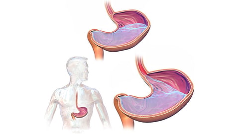 LAX Erosive Gastritis