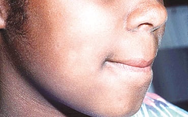 ಪಿಟ್ರಿಯಾಸಿಸ್ ಅಲ್ಬಾ