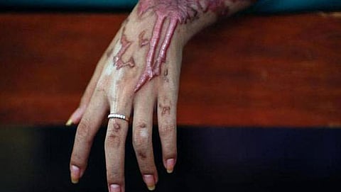 Acid attack on beauty parlour owner on outskirts of Patna