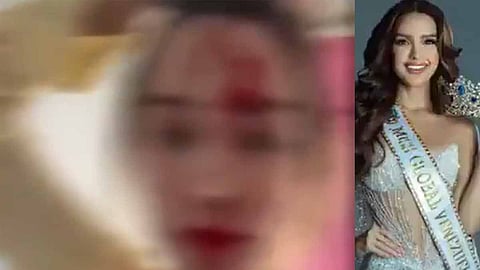 வெனிசுலா அழகிக்கு ஏற்பட்ட அவலம்..! ஒப்பனையாளர் தாக்கியதால் கோரமான அழகிய முகம்..!- வீடியோ