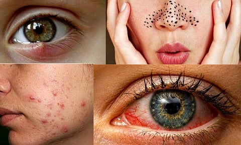 Skincare, BeautyTips   