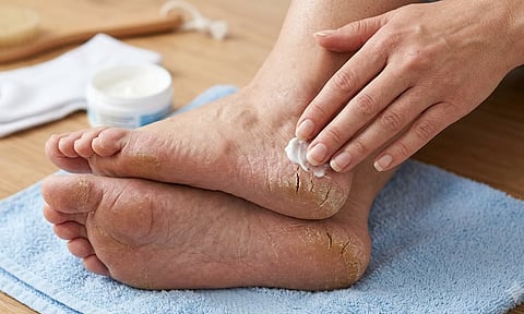  Cracked Heels Remedy