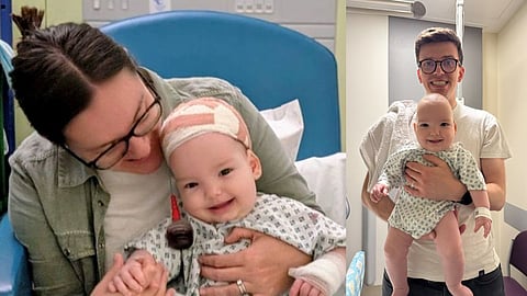 Doctors use nitinol coils to reshape underdeveloped baby skull