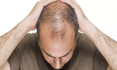 ஓ...! இதுதான் வழுக்கை விழுவதற்கு காரணமா?