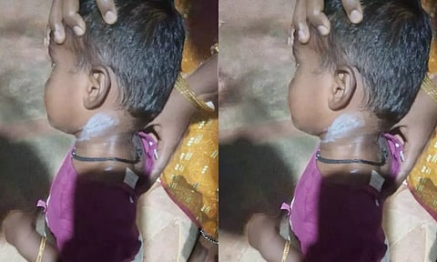 2½ வயது குழந்தைக்கு சூடு வைத்த அங்கன்வாடி ஊழியர்