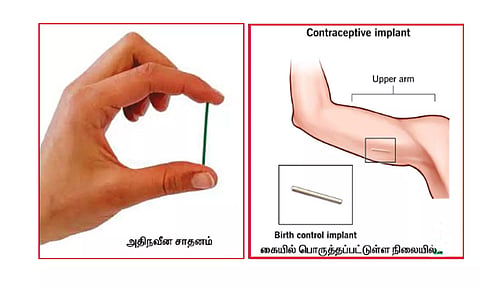 பெண்களுக்கான நவீன இலவச கருத்தடை சாதனம் அறிமுகம்