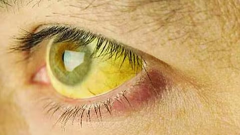 jaundice spread 50 students of paleri school confirmed with infection