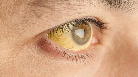 Jaundice outbreak in Kalamassery