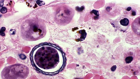 amoebic meningoencephalitis case alappuzha