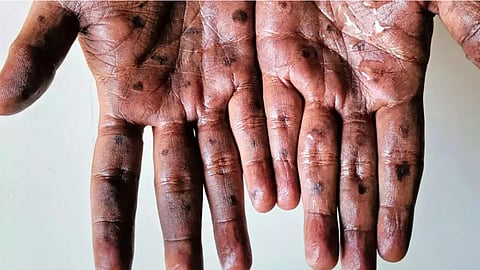 mpox 