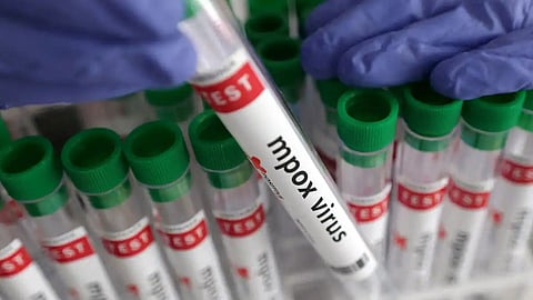 Mpox confirmed again in Kannur