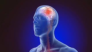 Know and prevent stroke അറിഞ്ഞിരിക്കാം, പ്രതിരോധിക്കാം സ്‌ട്രോക്കിനെ
