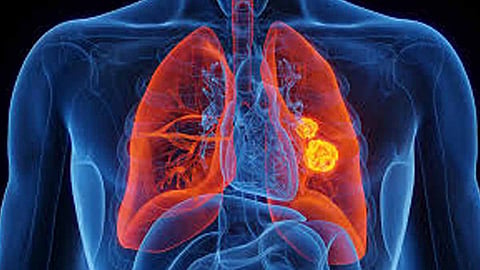 World's first urine test which promise to detect lung cancer in early stage