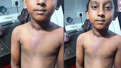 7-year-old boy suffers from heatstroke in Haripad