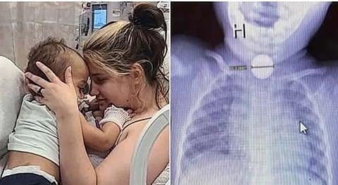 Baby Kai is in the arms of his mother Madeline Dunn (left) and the button battery seen in the baby's X-ray (right).