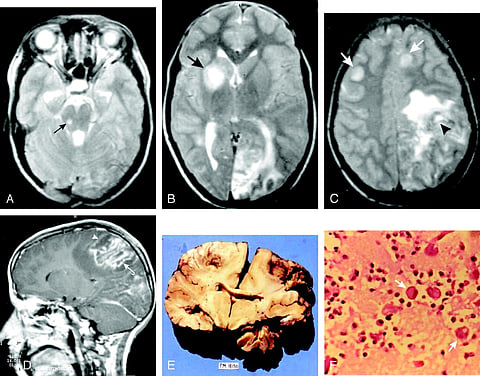 Amebic Meningoencephalitis