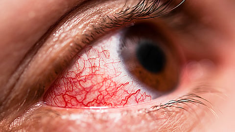 different types of Conjunctivitis and treatment