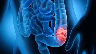 gastro intestinal cancer, symptoms