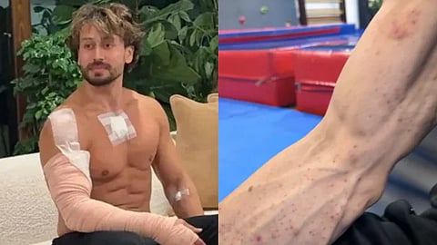 tiger shroff pellet injuries on the hand