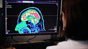 Brain tumour could now be detected using urine test 