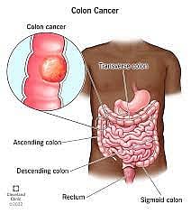 New genetic risks for colon cancer found by scientists