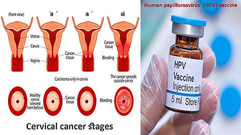 HPV vaccine for cervical cancer