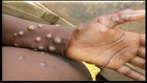 Congo is struggling to contain its biggest mpox outbreak