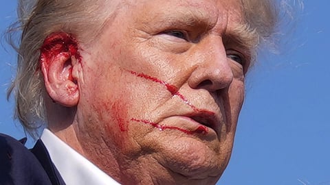 Injured Donald Trump.