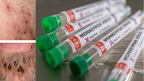 Monkeypox infection