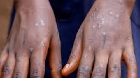 Kerala to issue revised Mpox guidelines after reporting India's first case of new strain