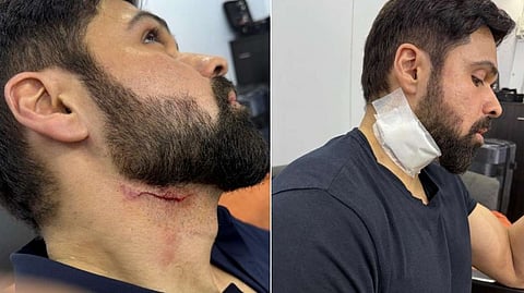 Actor Emraan Hashmi injured on sets of Telugu film 'Goodachari 2' in Hyderabad