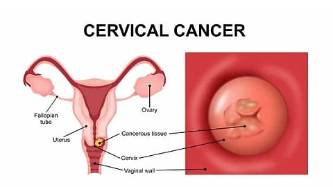 Cervical cancer descriptive image