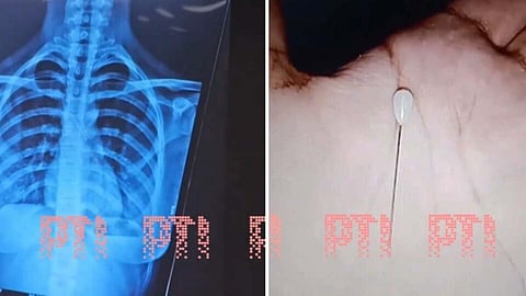 Needle found in one-year-old's body,