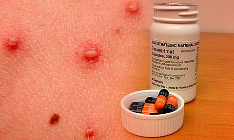 Cofepris autoriza ensayo clínico de medicamento contra mpox o viruela símica