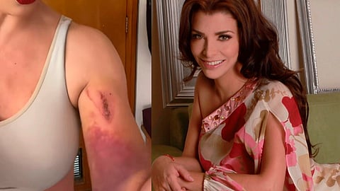 Actriz Lisset cae a coladera y resulta herida; así le quedó el brazo [Video]