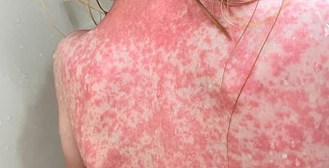 Confirman tres casos de sarampión en Maravatío, Michoacán; SSM activa cerco sanitario