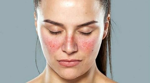 Michoacán, entre los estados que respaldan iniciativas sobre lupus