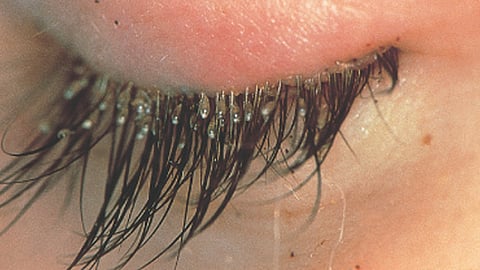 Si la persona tiene piojos o liendres en otras partes del cuerpo, es muy probable que estas migren otras zonas con bellos, entre ellas las pestañas (Foto: Captura)