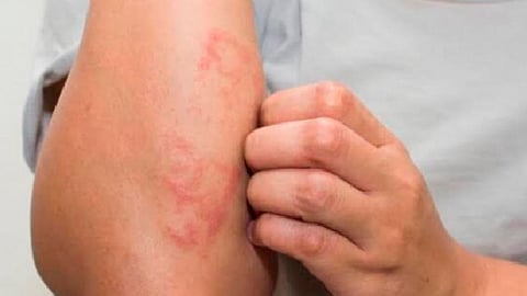 Puebla acumula 14 casos de lepra detectados en 11 municipios