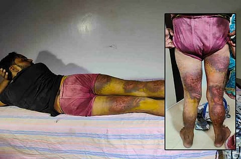पुलिसकर्मियों की पिटाई के बाद शरीर पर उभरे घाव 