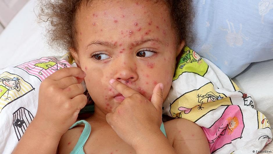 India becomes measles capital of the world, registers highest number of cases this year