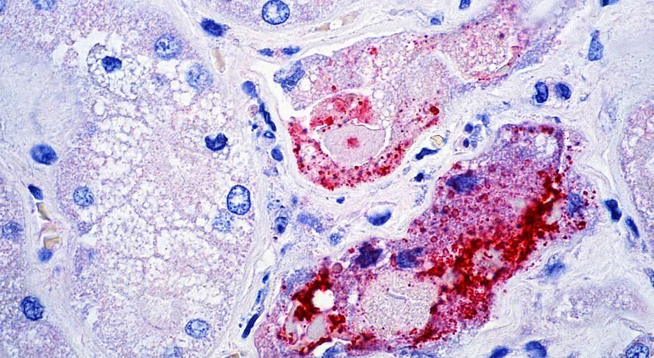Explained: What is Nipah Virus?