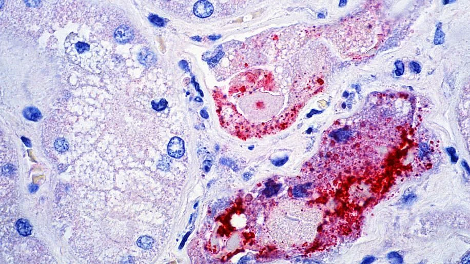 Nipah virus outbreak: What you need to know
